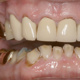 Minimally Invasive Management of Severe Erosive Tooth Wear: A Hands-on Workshop