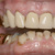 Minimally Invasive Management of Severe Erosive Tooth Wear: A Hands-on Workshop