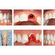 Immediate Implant Placement for General Dentists: Hands-on Course