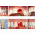 Immediate Implant Placement for General Dentists: Hands-on Course